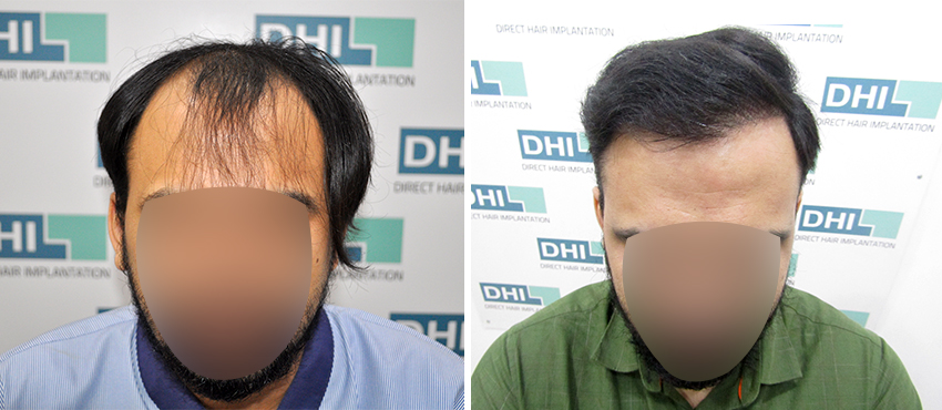 DHI before & after hair transplant results